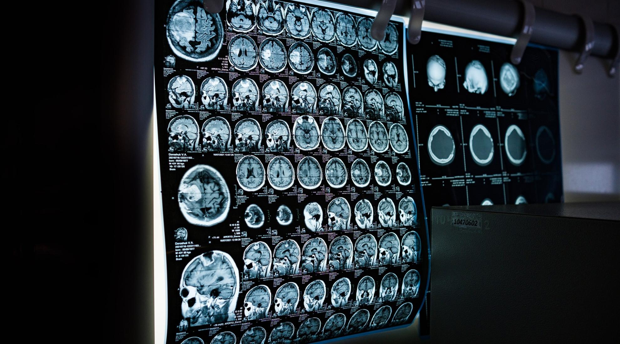 MRI scanning