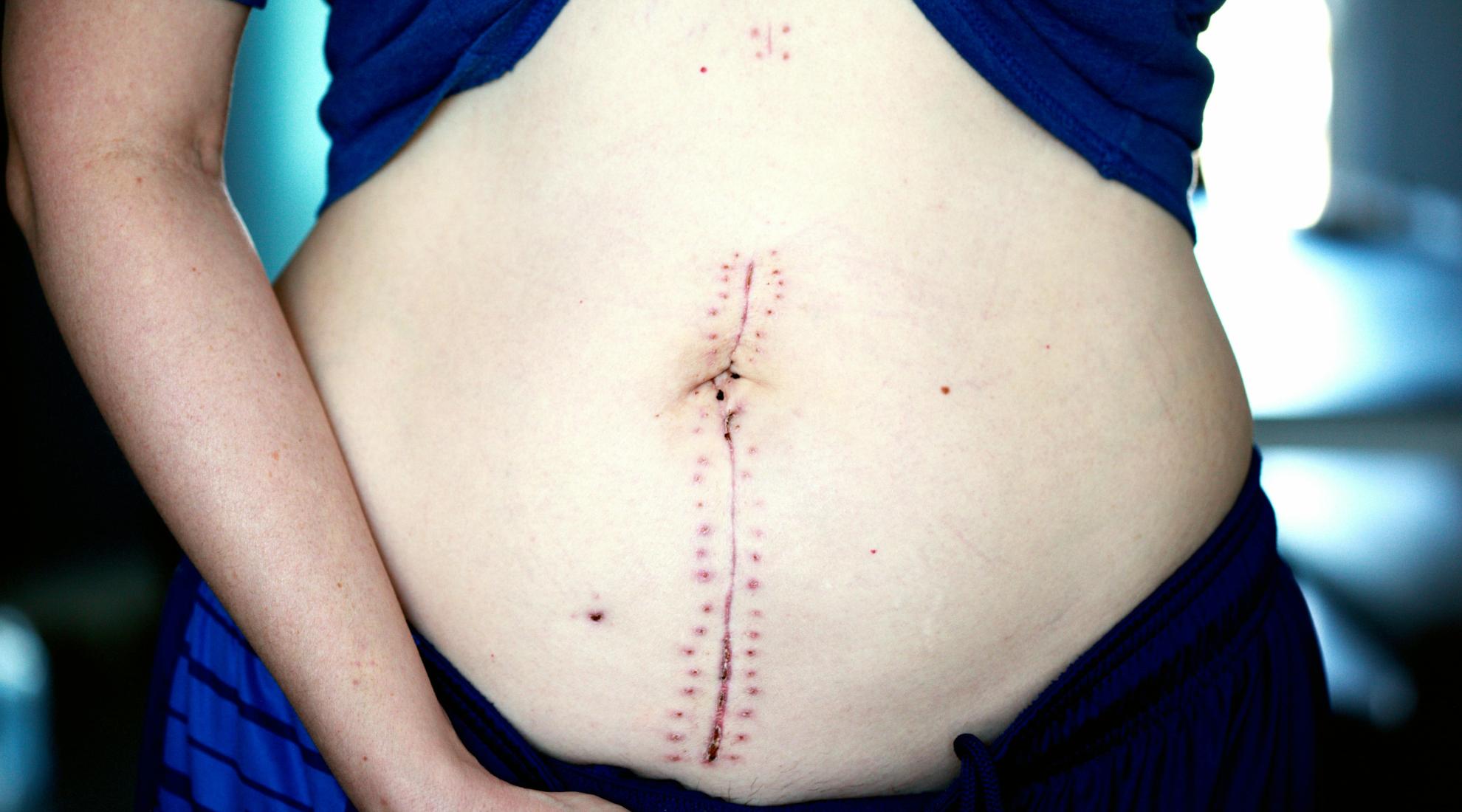 Abdominal surgery