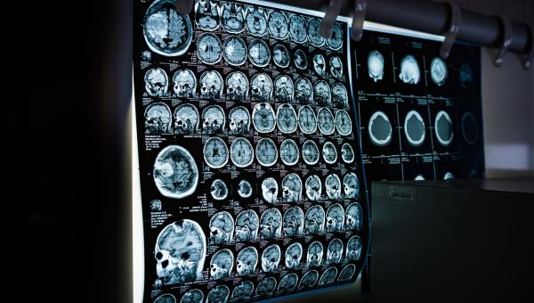 MRI scanning