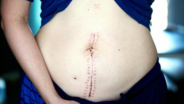 Abdominal surgery