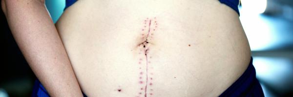 Abdominal surgery