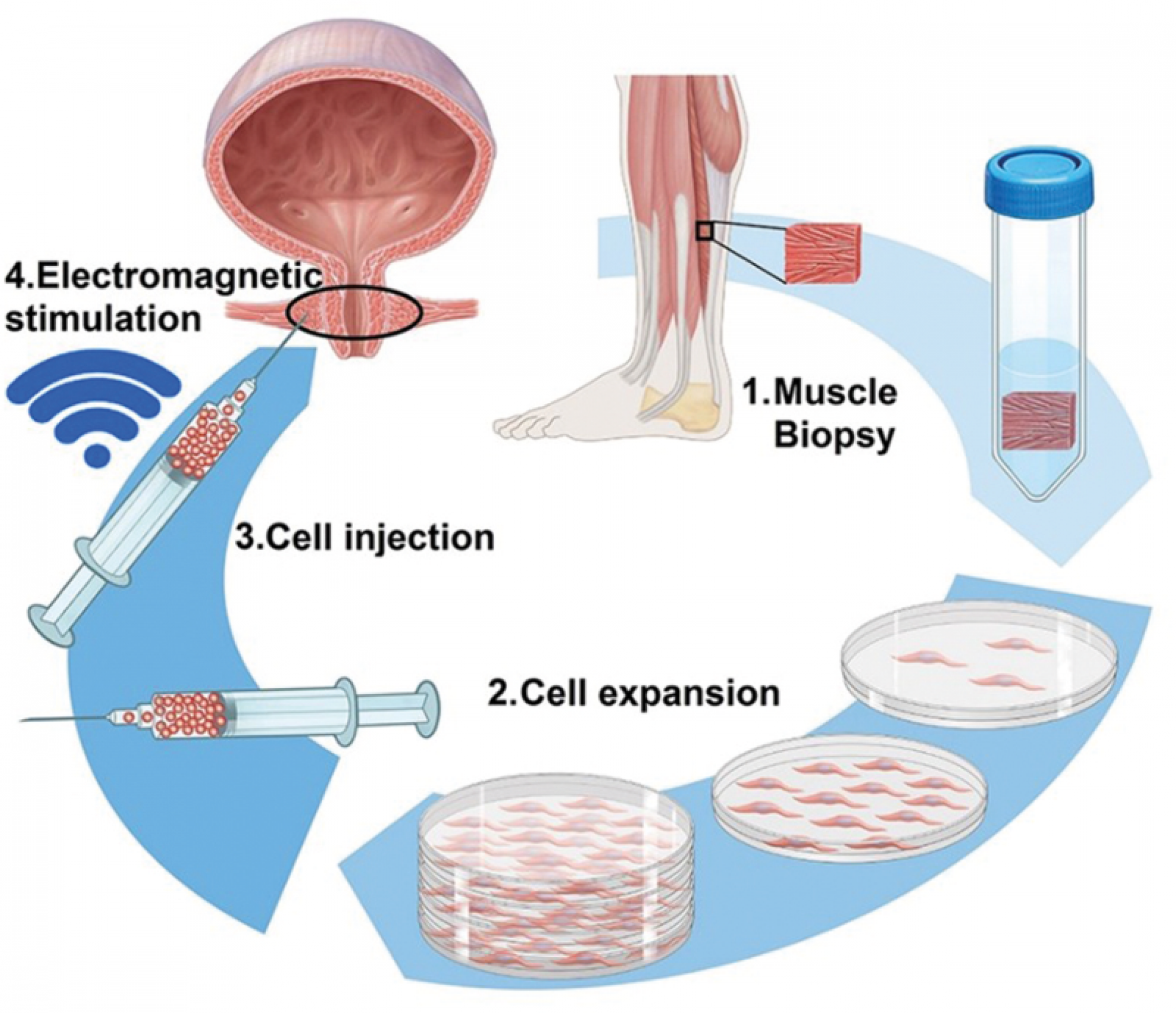 MUVON’s process for harvesting and re-injecting cells to stimulate muscle growth. 